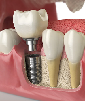 Dental Implants