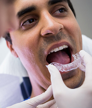 Invisalign Clear Aligners