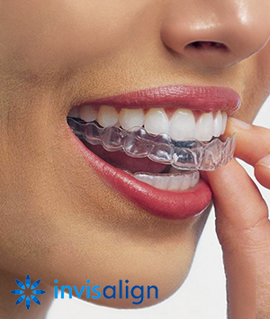 Invisalign Clear Aligners