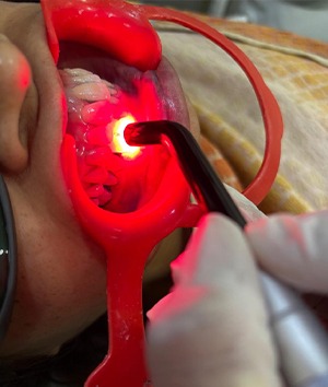 Laser Dentistry