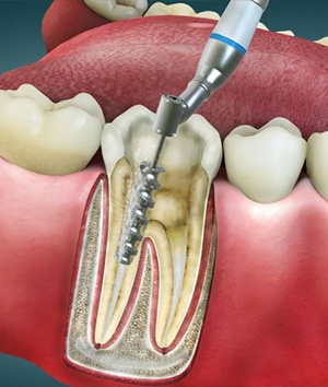 Endodontics (Root Canal Treatment)