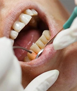 Laser Dentistry
